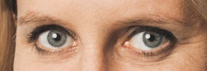 Beispielsbild von symmetrischen Reflexen auf der Hornhaut in beiden Augen